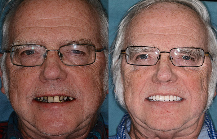 Customized Full Denture Set | Natural Ivory & Classic White for Comfortable, Youthful Smiles
