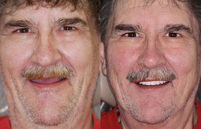 Customized Full Denture Set | Natural Ivory & Classic White for Comfortable, Youthful Smiles