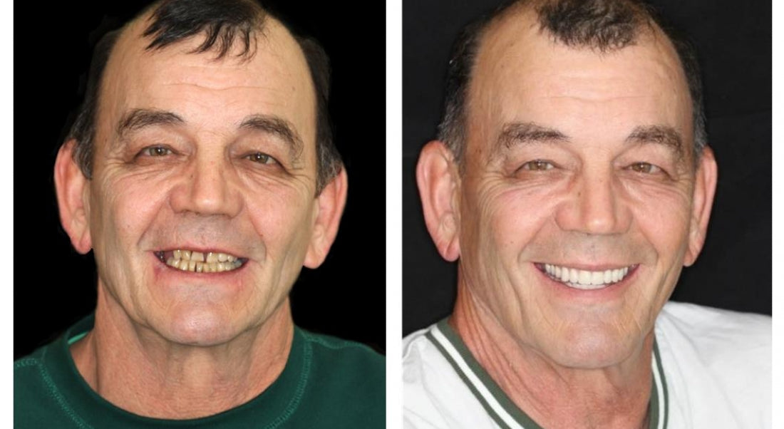 Customized Full Denture Set | Natural Ivory & Classic White for Comfortable, Youthful Smiles
