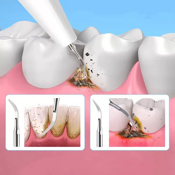 Dental Calculus Plaque Removal Tool | Tooth Cleaning Tool for Dental Hygiene