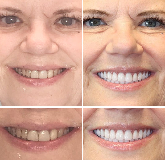 Customized Full Denture Set | Natural Ivory & Classic White for Comfortable, Youthful Smiles
