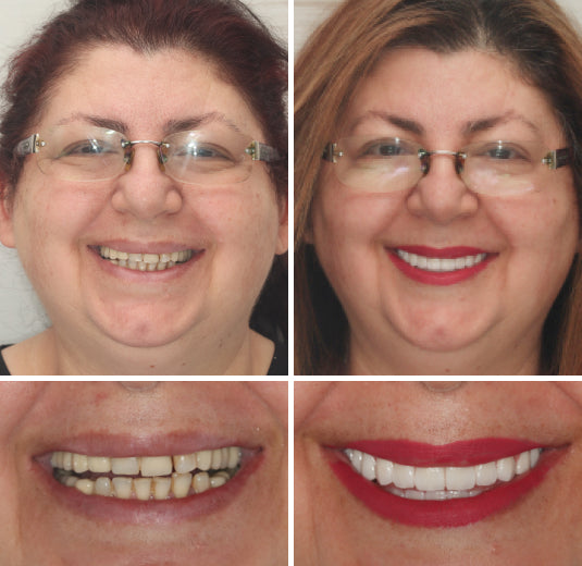 Customized Full Denture Set | Natural Ivory & Classic White for Comfortable, Youthful Smiles