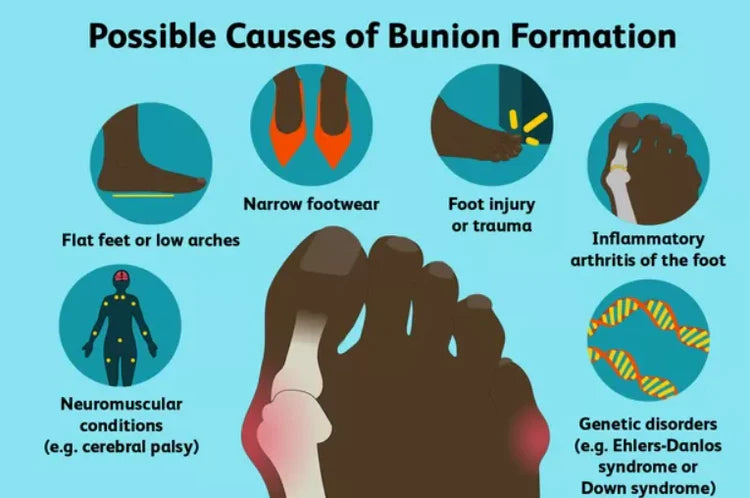 BunionGuard™ | Bunion Corrector for Pain Relief & Alignment | Adjustable Orthopedic Support for All Foot Sizes