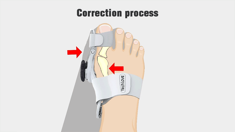 BunionGuard™ | Bunion Corrector for Pain Relief & Alignment | Adjustable Orthopedic Support for All Foot Sizes