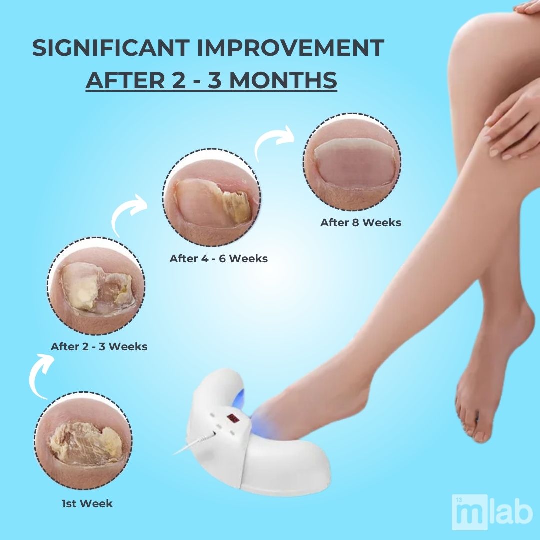 Nail Fungus Laser Treatment | Non-Invasive, Effective & Safe Solution for Healthy Nails