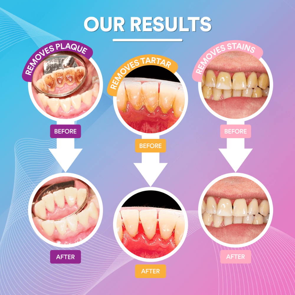PureSmile™ Ultrasonic Tooth Cleaner | Advanced Teeth Cleaning Technology