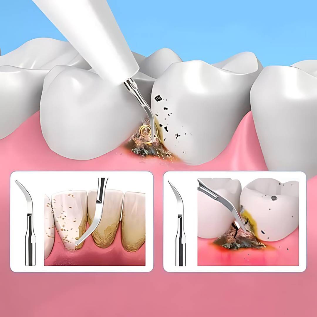 Tartar Removal & Plaque Cleaner Kit – Ultrasonic Teeth Cleaner Device for At-Home Deep Dental Hygiene
