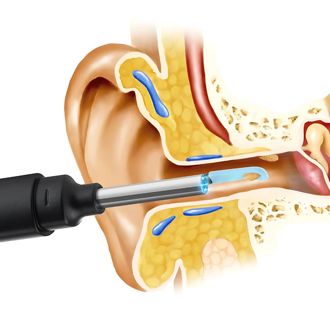 Ear Wax Removal Tool with Camera | Smart Otoscope Ear Cleaner | HD Visual Endoscope with 6 LEDs | Wi-Fi App