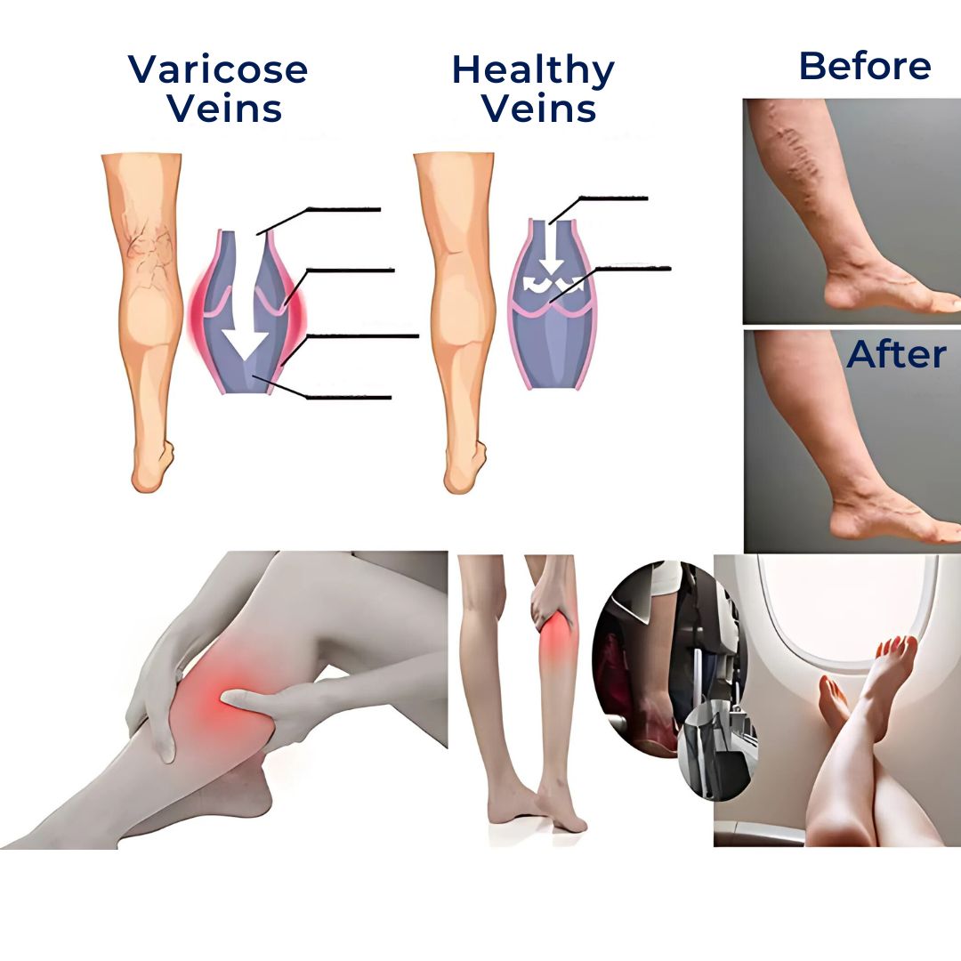 Support Tights for Varicose Veins – Compression Stockings to Improve Circulation & Relieve Swollen Legs