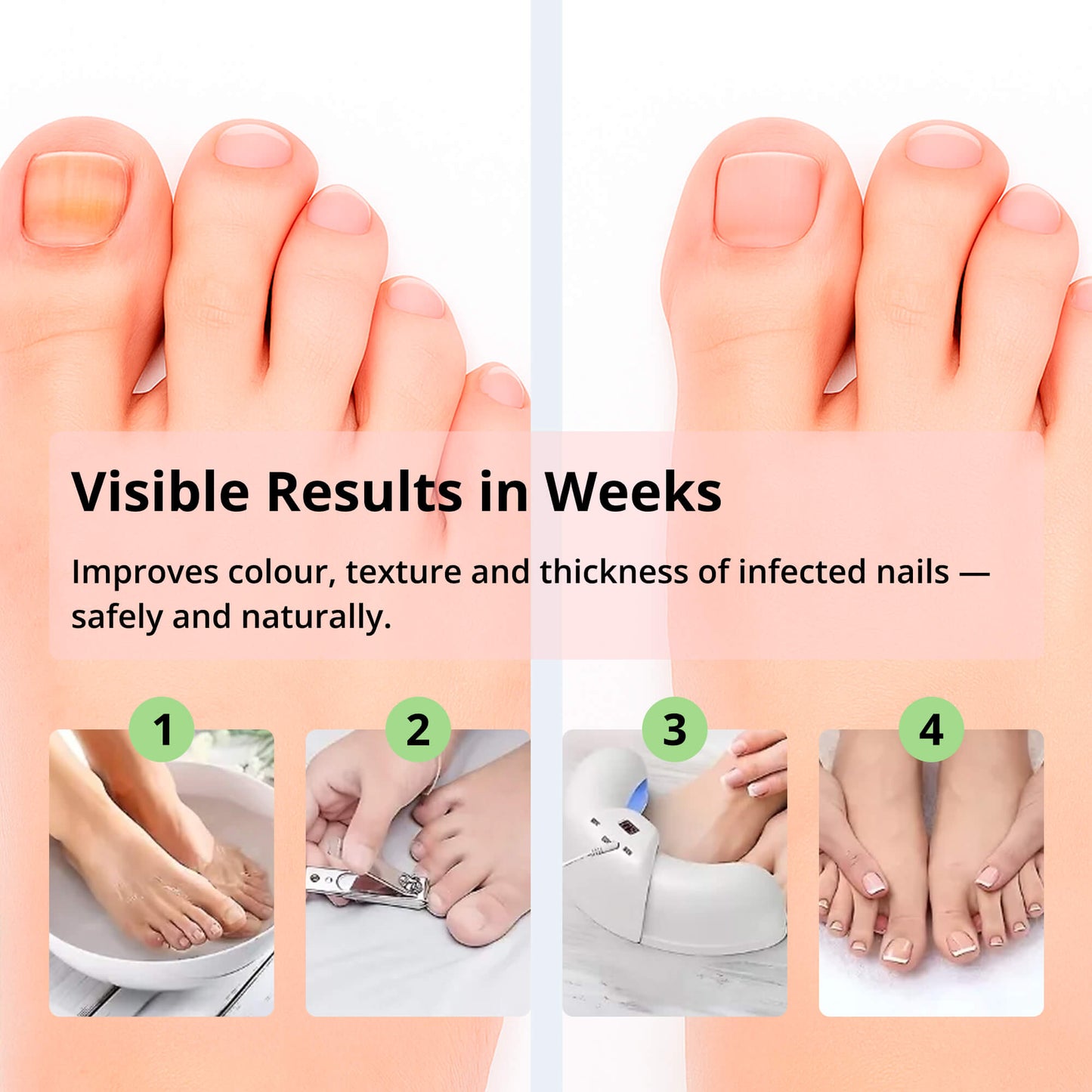 Laser Nail Fungus Removal Device | Advanced Home Treatment with Red & Blue Light for Healthy Nails