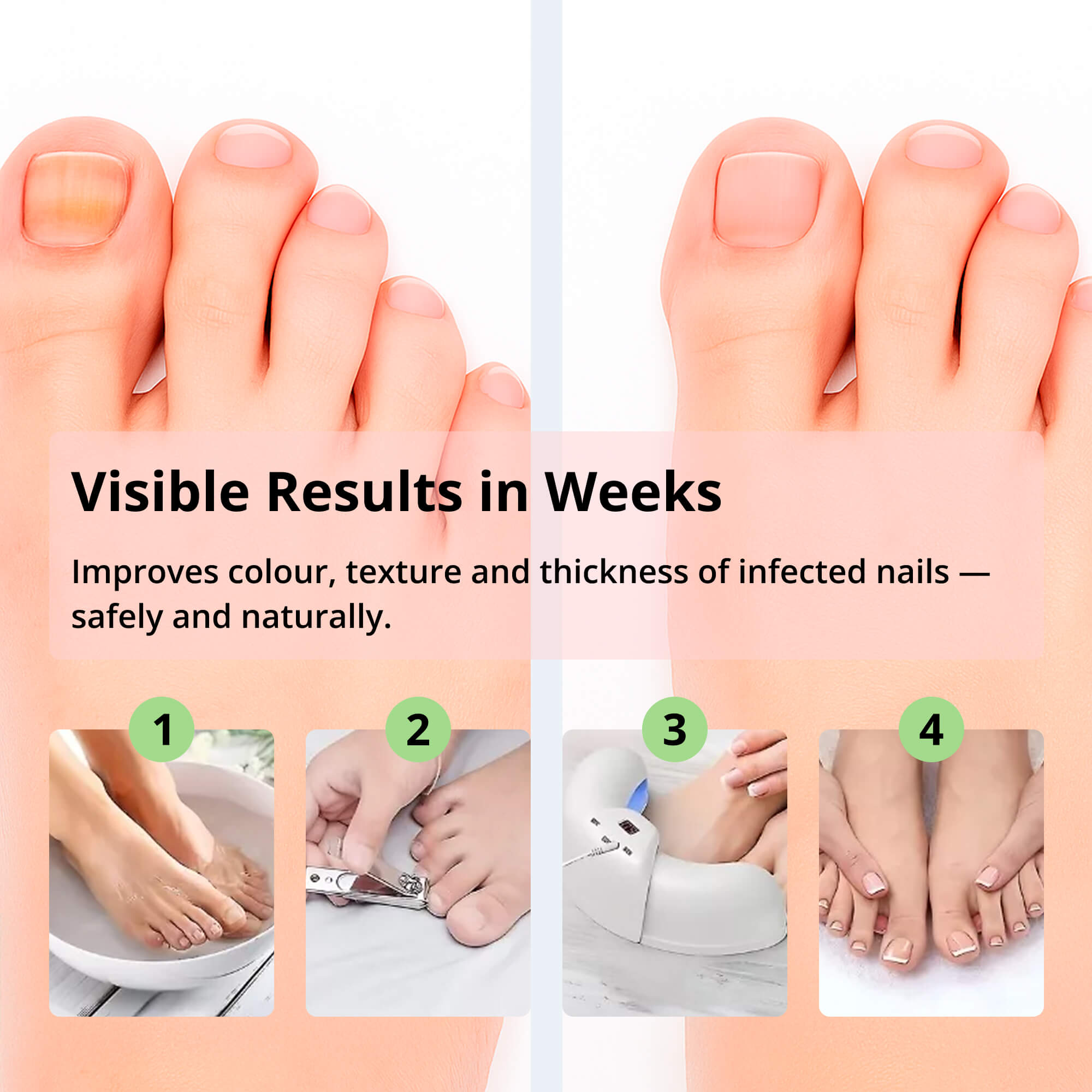 Laser Nail Fungus Removal Device | Advanced Home Treatment with Red & Blue Light for Healthy Nails