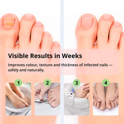 Laser Nail Fungus Removal Device | Advanced Home Treatment with Red & Blue Light for Healthy Nails