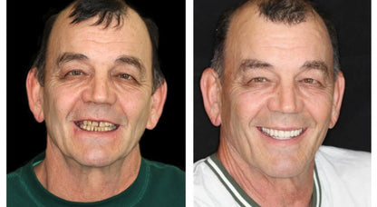 Customized Full Denture Set | Natural Ivory & Classic White for Comfortable, Youthful Smiles