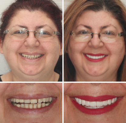 Customized Full Denture Set | Natural Ivory & Classic White for Comfortable, Youthful Smiles