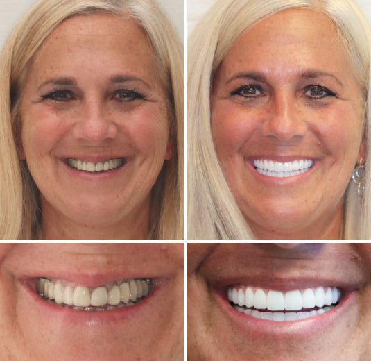 Customized Full Denture Set | Natural Ivory & Classic White for Comfortable, Youthful Smiles