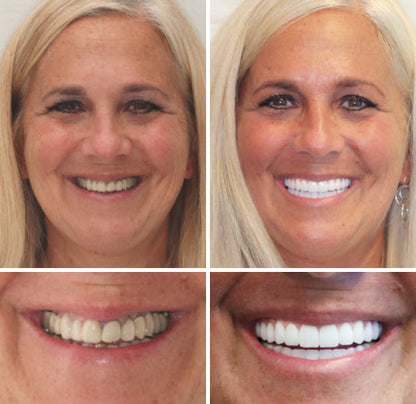 Customized Full Denture Set | Natural Ivory & Classic White for Comfortable, Youthful Smiles