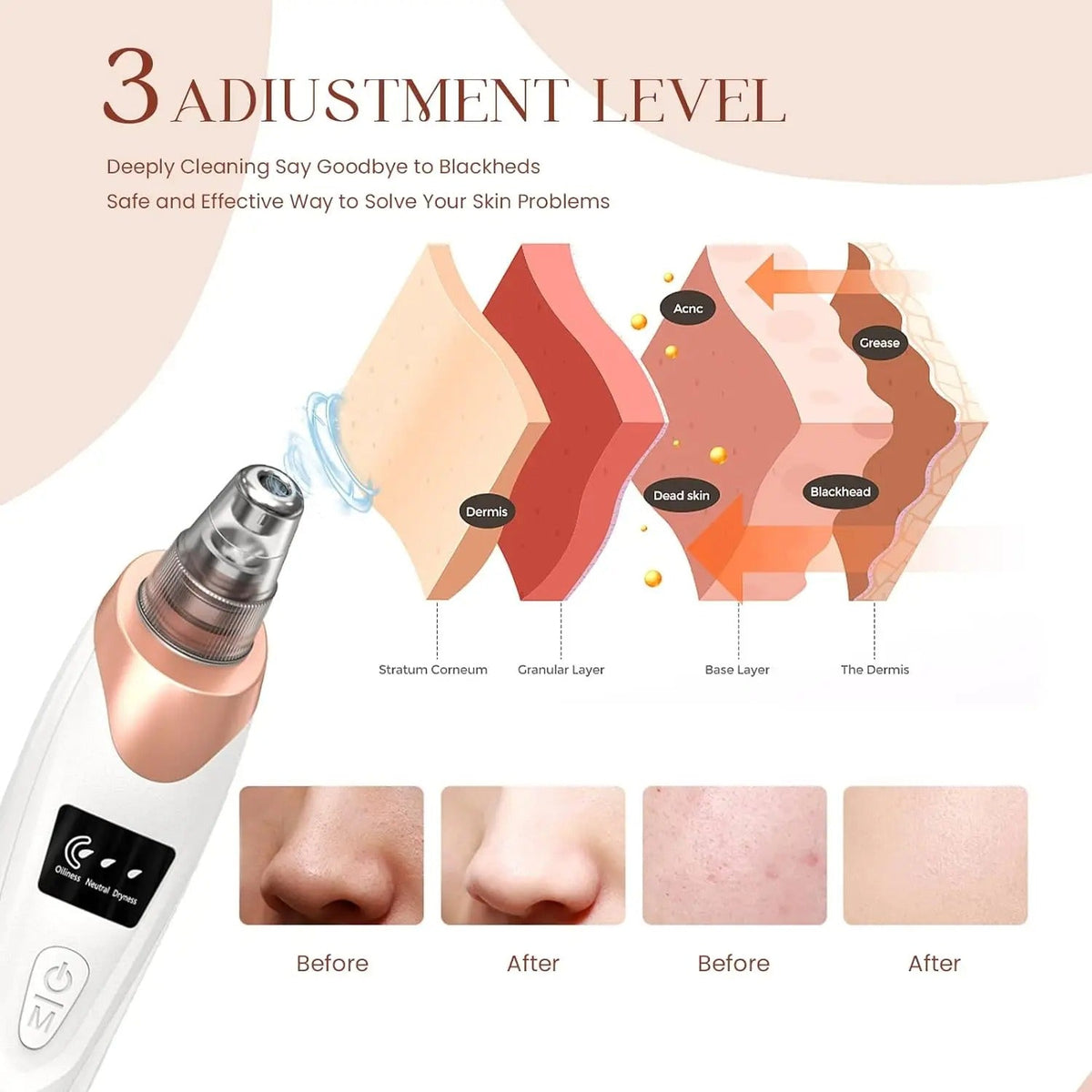 AeriaSkin™ Blackhead Remover Vacuum Pore Cleaner | Adjustable Suction, Multi-Functional Tool for Deep Cleansing & Acne Treatment at Home