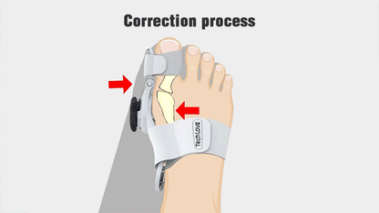 BunionGuard™ | Bunion Corrector for Pain Relief & Alignment | Adjustable Orthopedic Support for All Foot Sizes