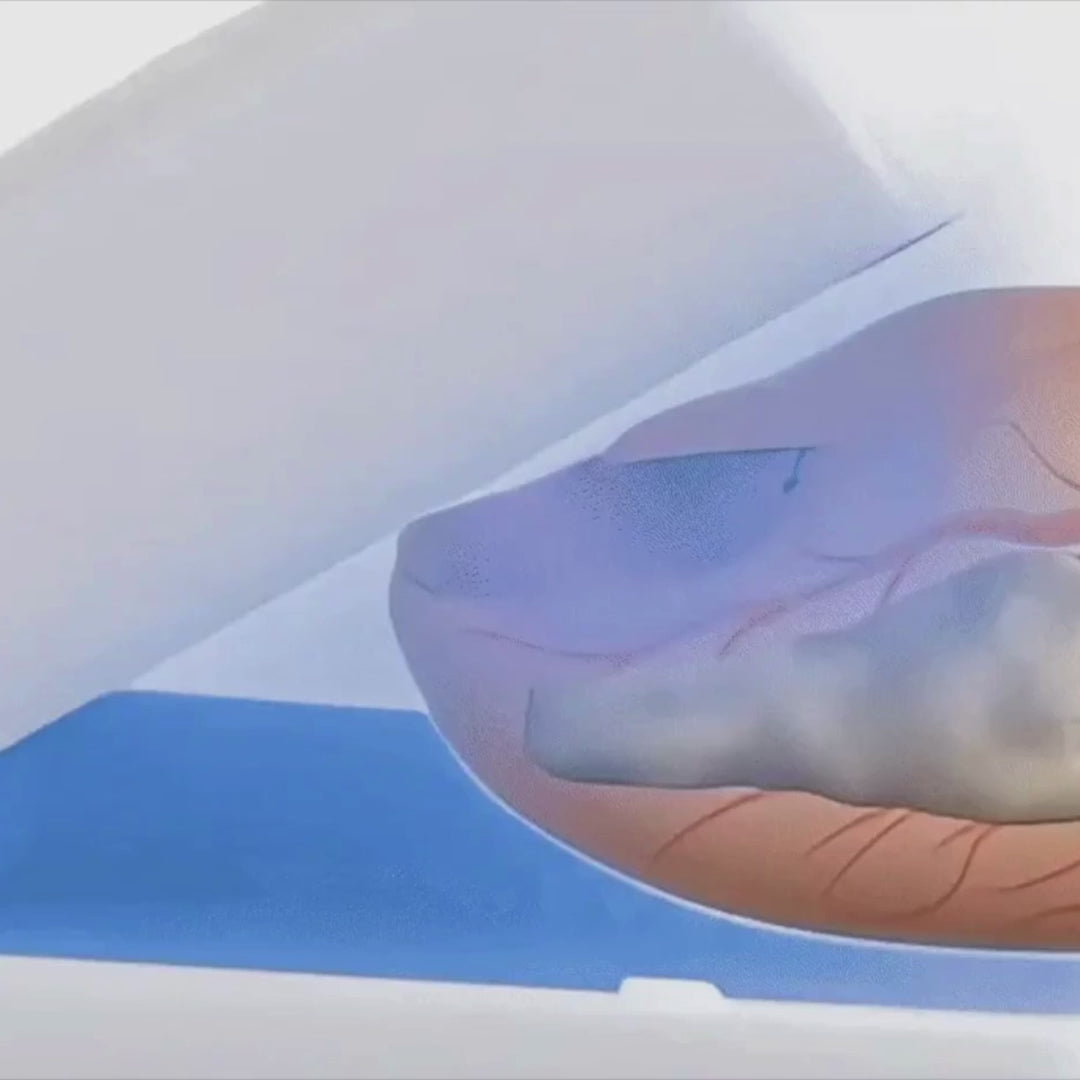 Nail Fungus Laser Treatment Device | Effective, Portable & Ideal for Home Use