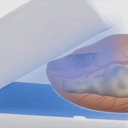 Nail Fungus Laser Treatment Device | Effective, Portable & Ideal for Home Use